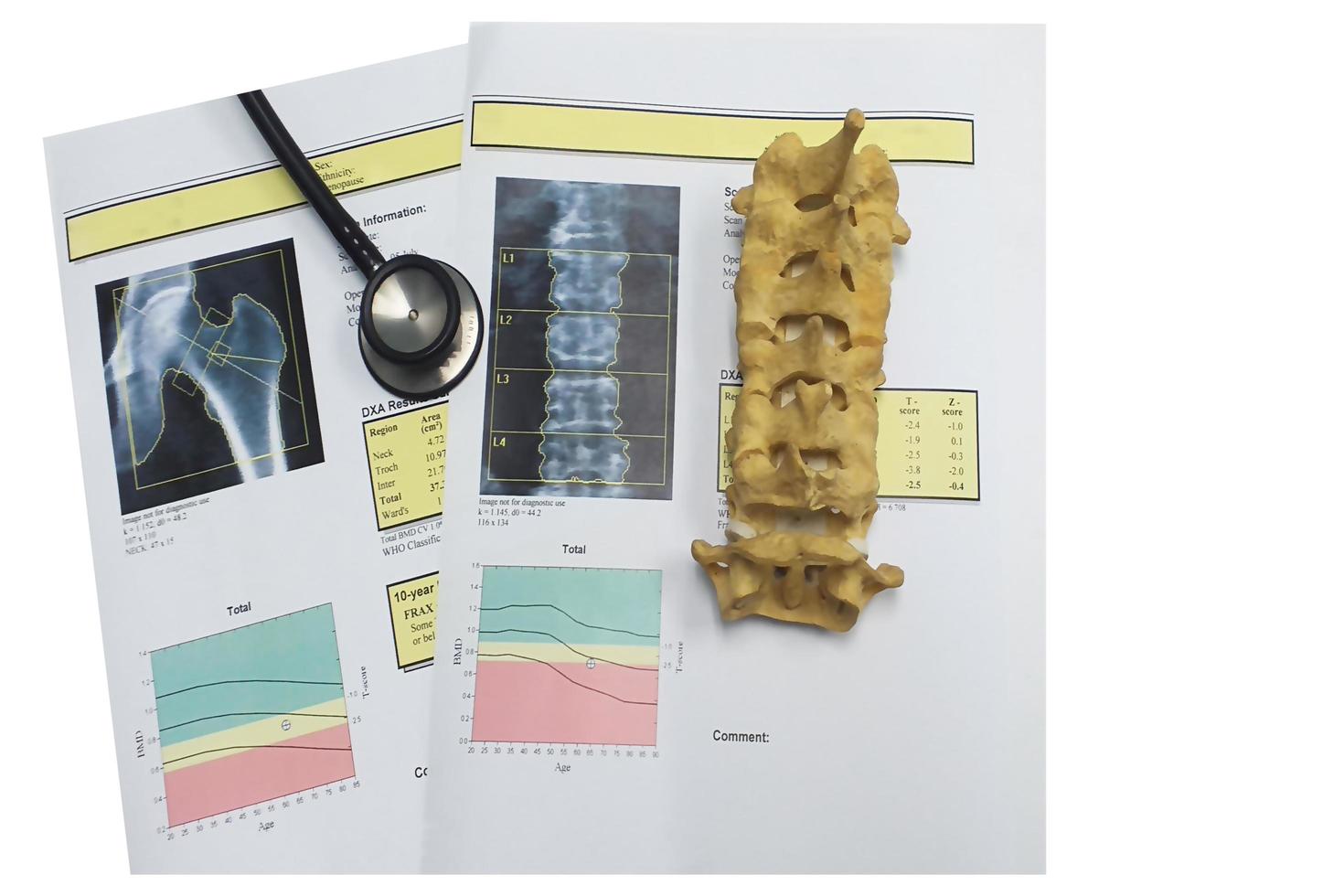 bone density hip and lumbarspine Result Osteoporosis photo