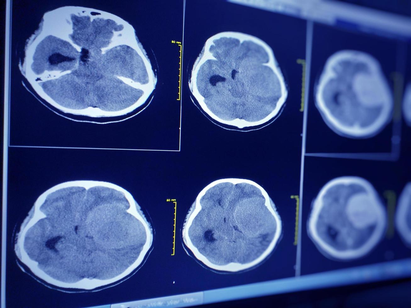 CT Brain Seven cm. diameter hyperdensity mass with lobulated surface at extra-axial lateral to Lt frontal and temporal lobe. photo