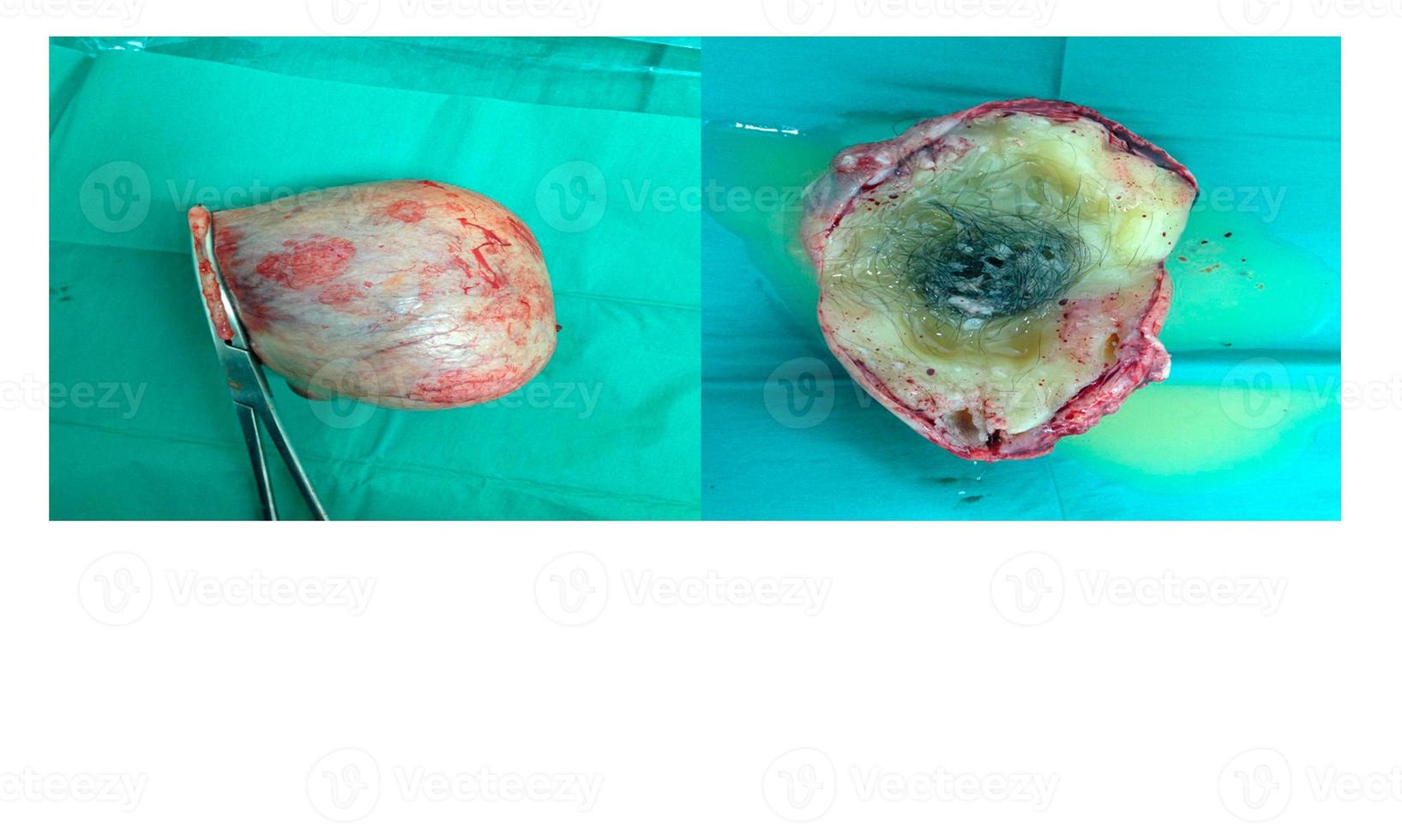 Dermoid Cyst Medical image. photo