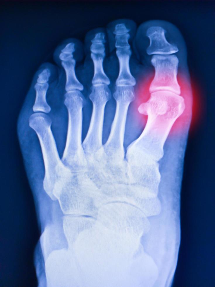 Pie de rayos X y artritis en la articulación metatarsofalángica. foto