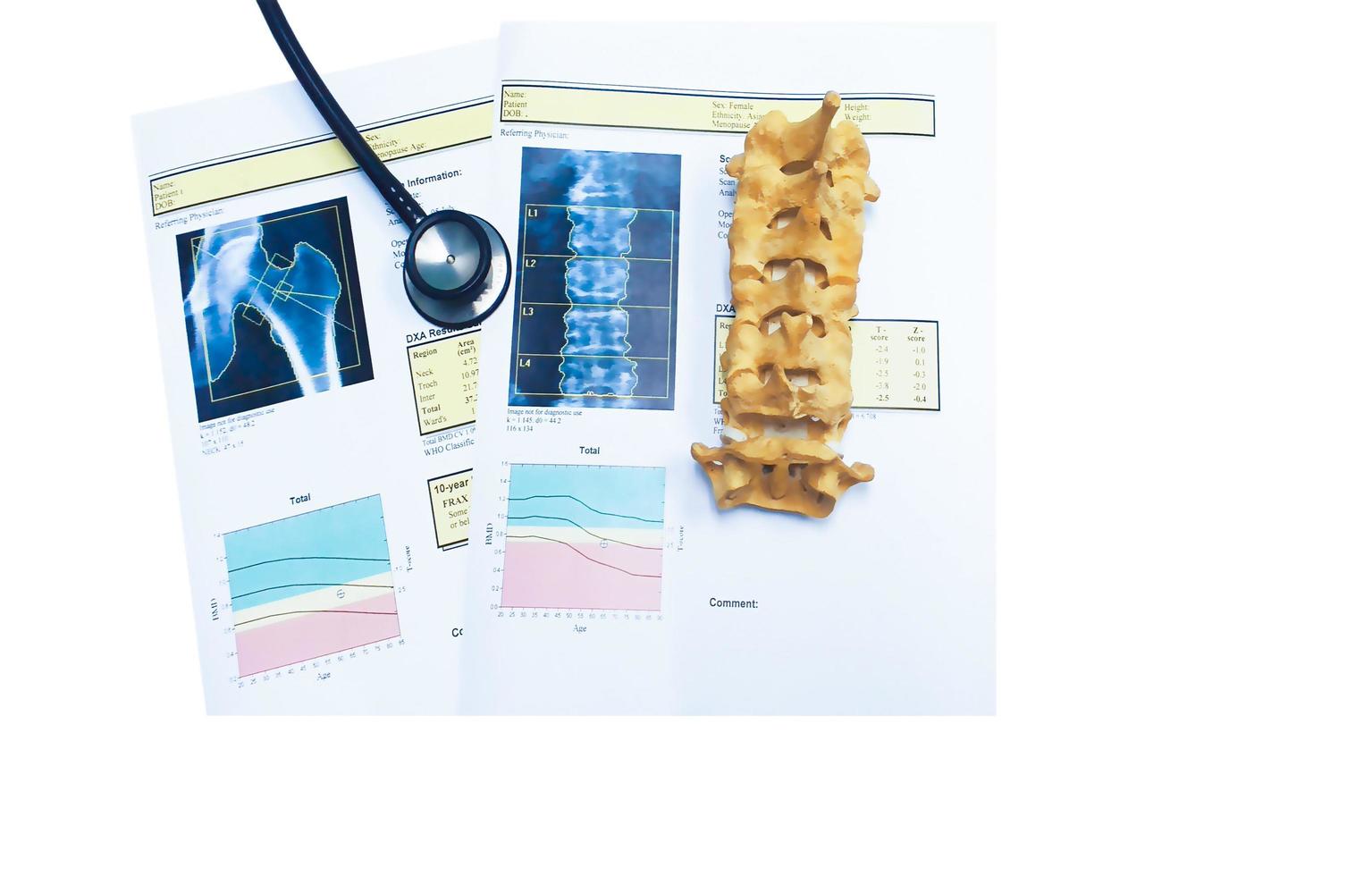 bone density hip and lumbarspine Result Osteoporosis photo