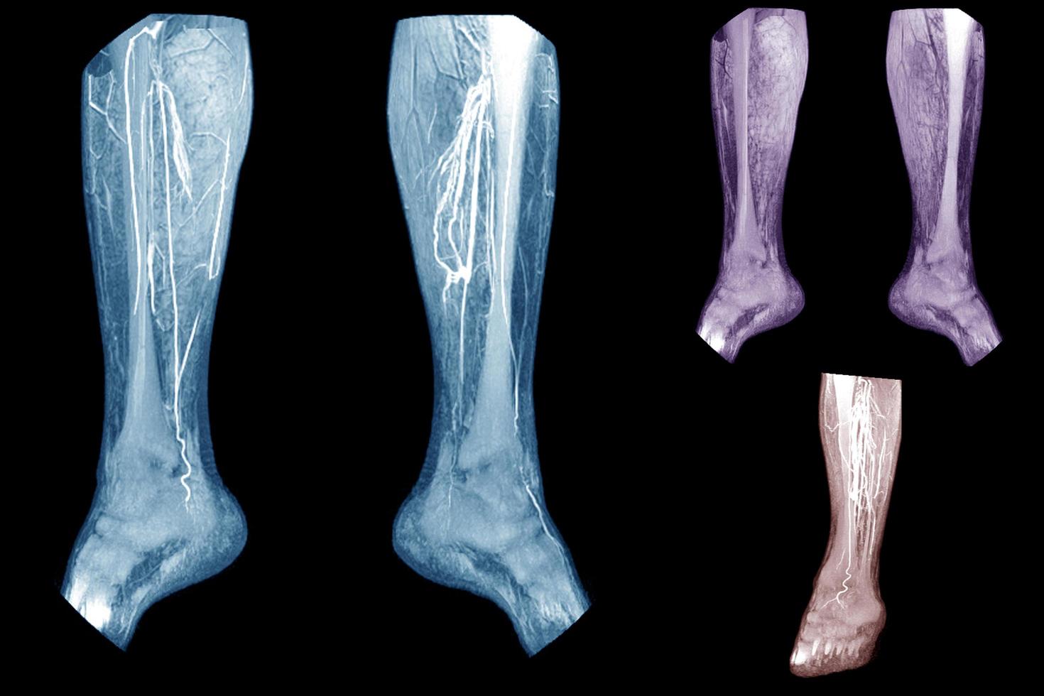 Computed tomography angiography  CT angiography or CTA of lower extremities photo