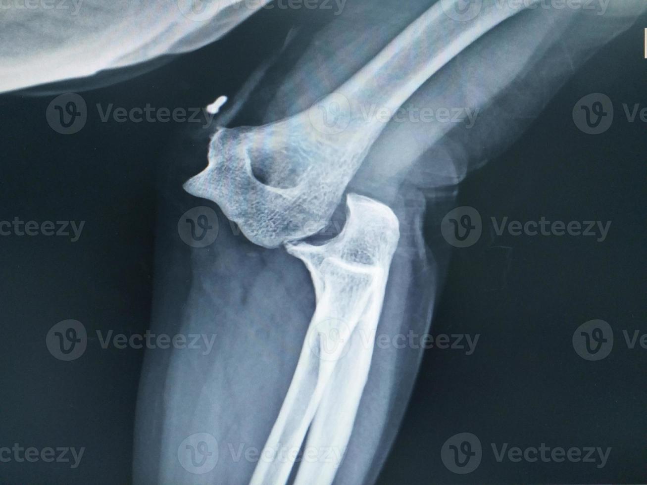 Elbow joint dislocation x-ray image. photo