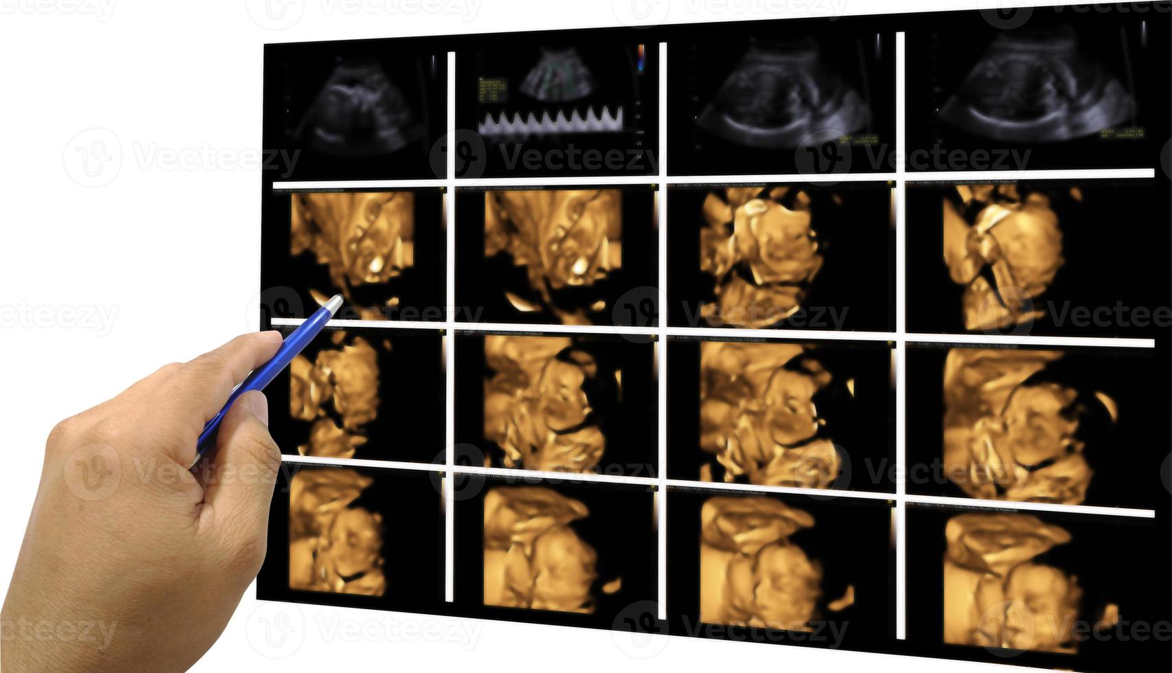Hand doctor holdding a pen on image Ultrasound 3D -4D of baby in mother's womb. photo