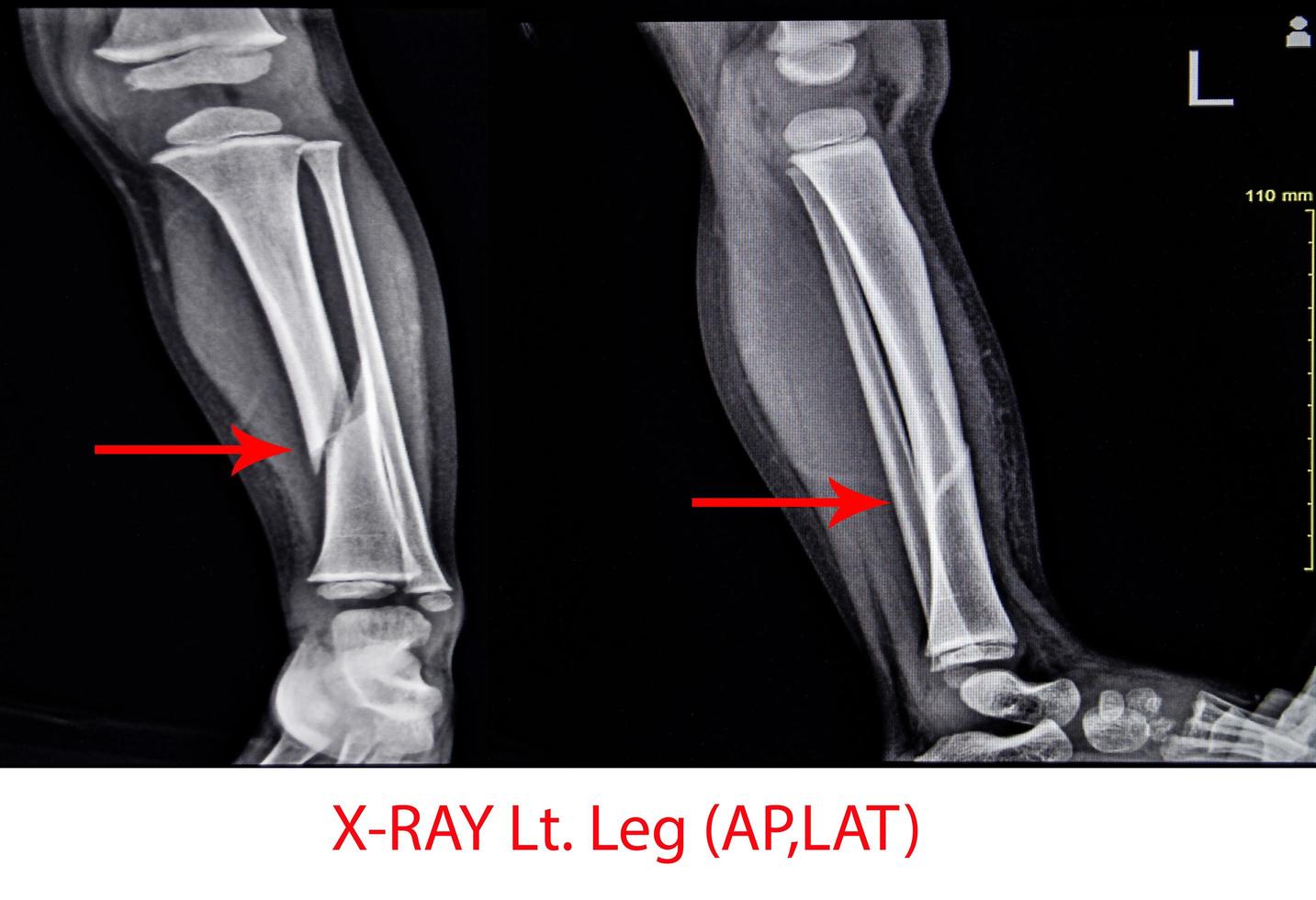 X-ray Left Leg AP Lat fracture Tibia. photo