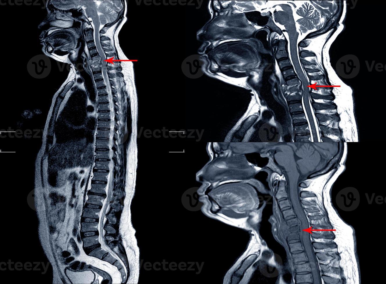 MRI of THORACOLUMBAR SPINE IMPRESSION: Moderate Pathological