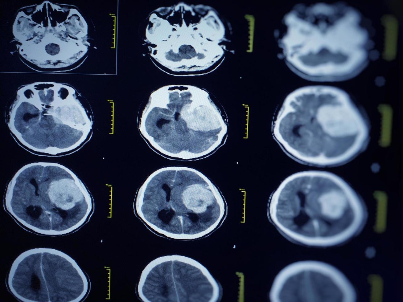 CT Brain Seven cm. diameter hyperdensity mass with lobulated surface at extra-axial lateral to Lt frontal and temporal lobe. photo
