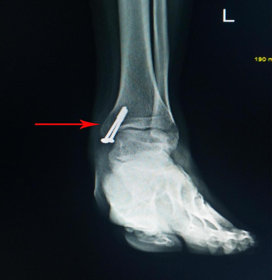 X-ray foot after operation fix screws in medial malleolus tibia. photo