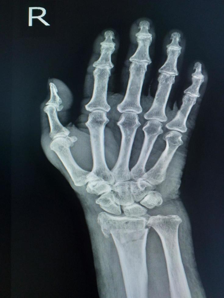 Film x-ray wrist  fracture distal radius. photo