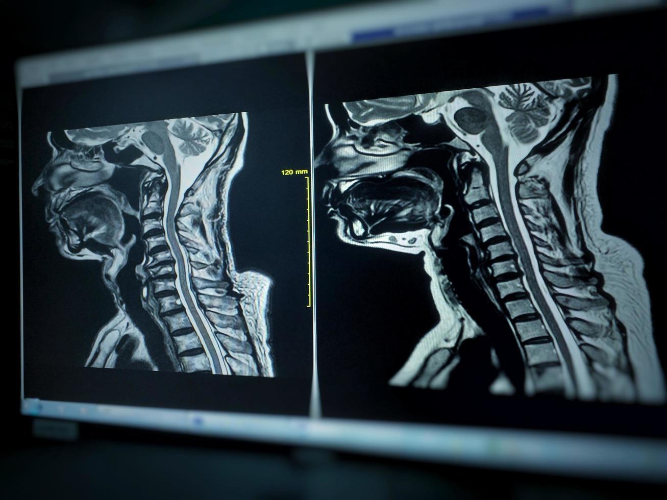 resonancia magnética de la columna cervical muestra compresión moderada de la médula espinal c4-c5 foto