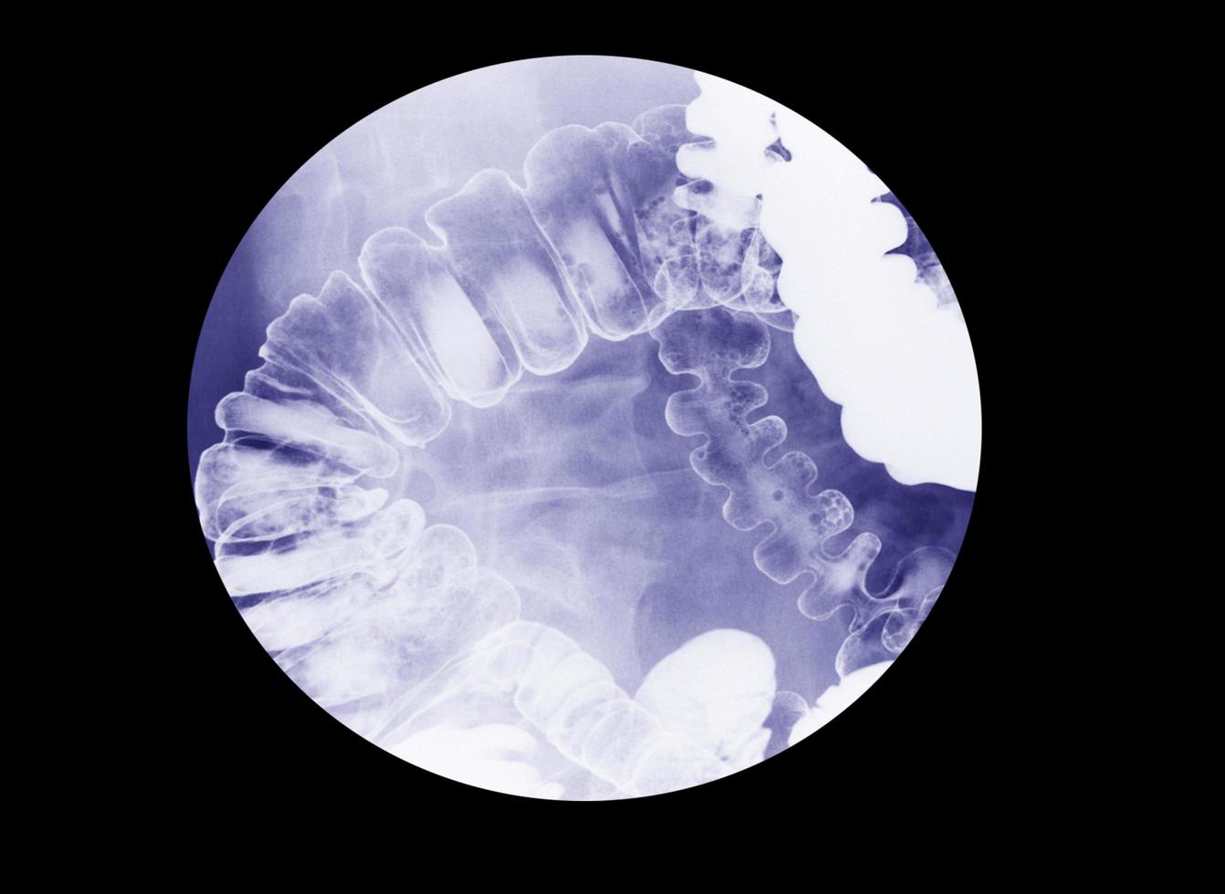 Barium enema examination photo