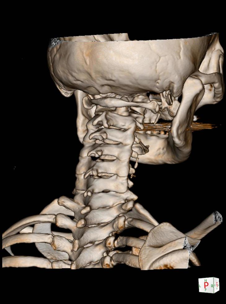 tomografía computarizada de la columna cervical 3 d render. foto