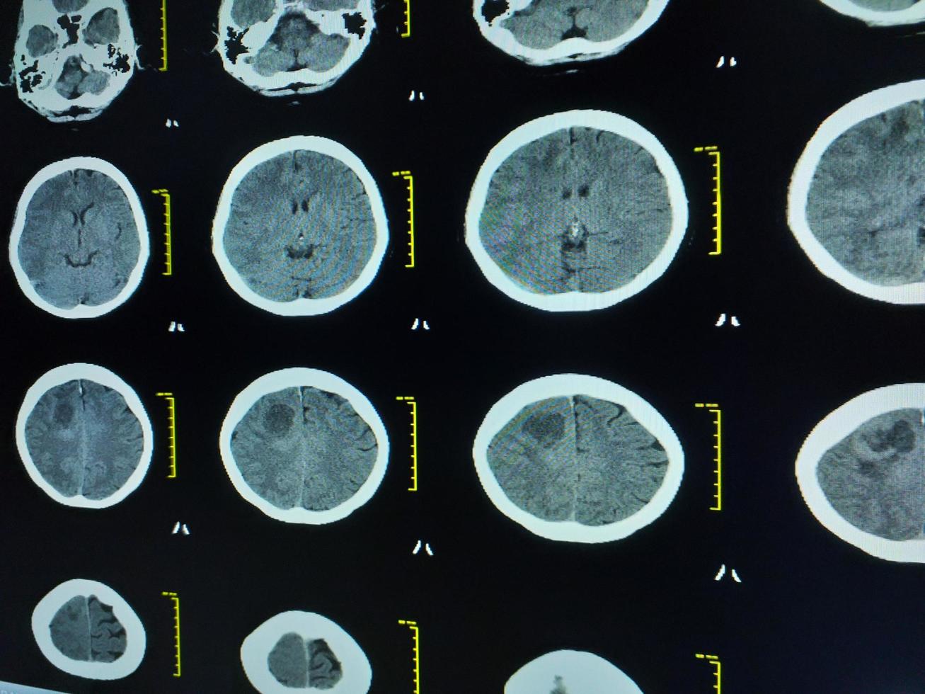 CT Brain History Headache Finding mass with ill-defined margin and surrounding edema photo