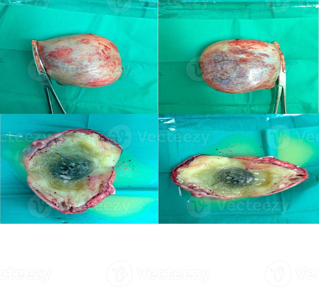 Dermoid Cyst Medical image. photo