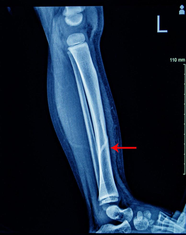 X-ray Left Leg AP Lat fracture Tibia. photo