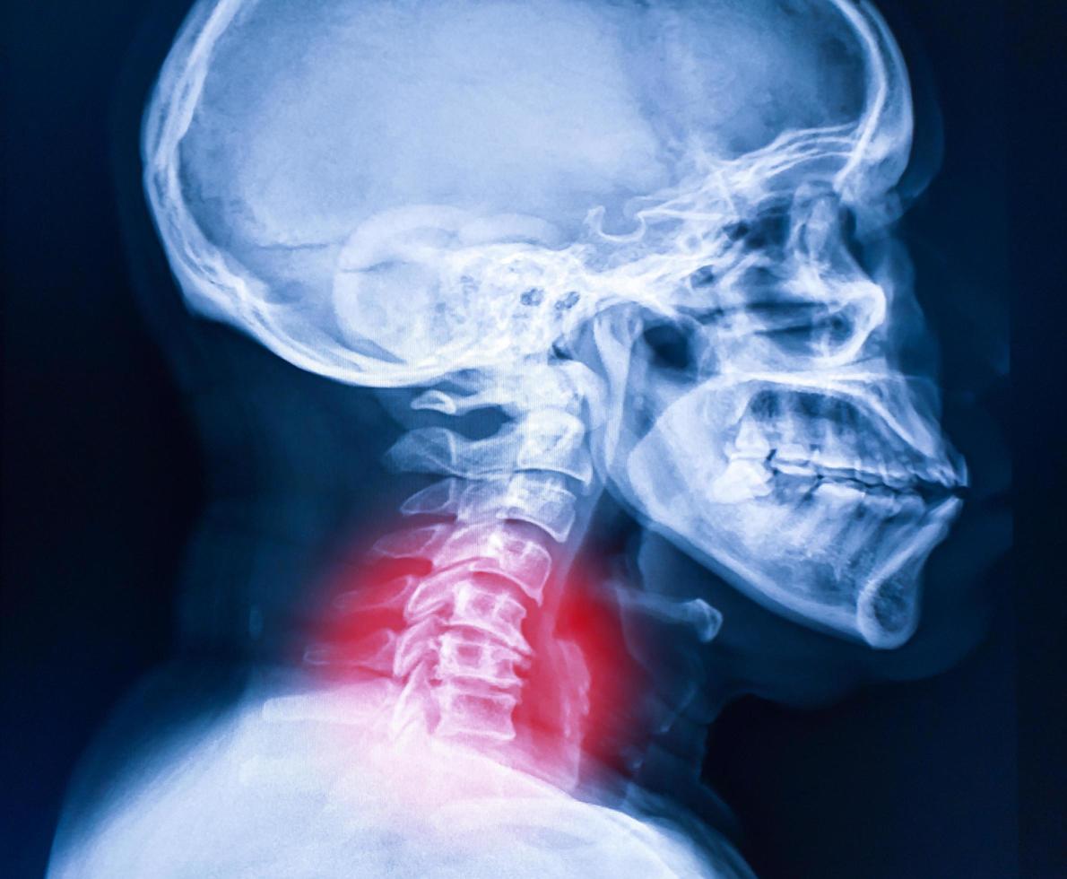 imagen de rayos x de la columna cervical, imagen de rayos x del cuello foto