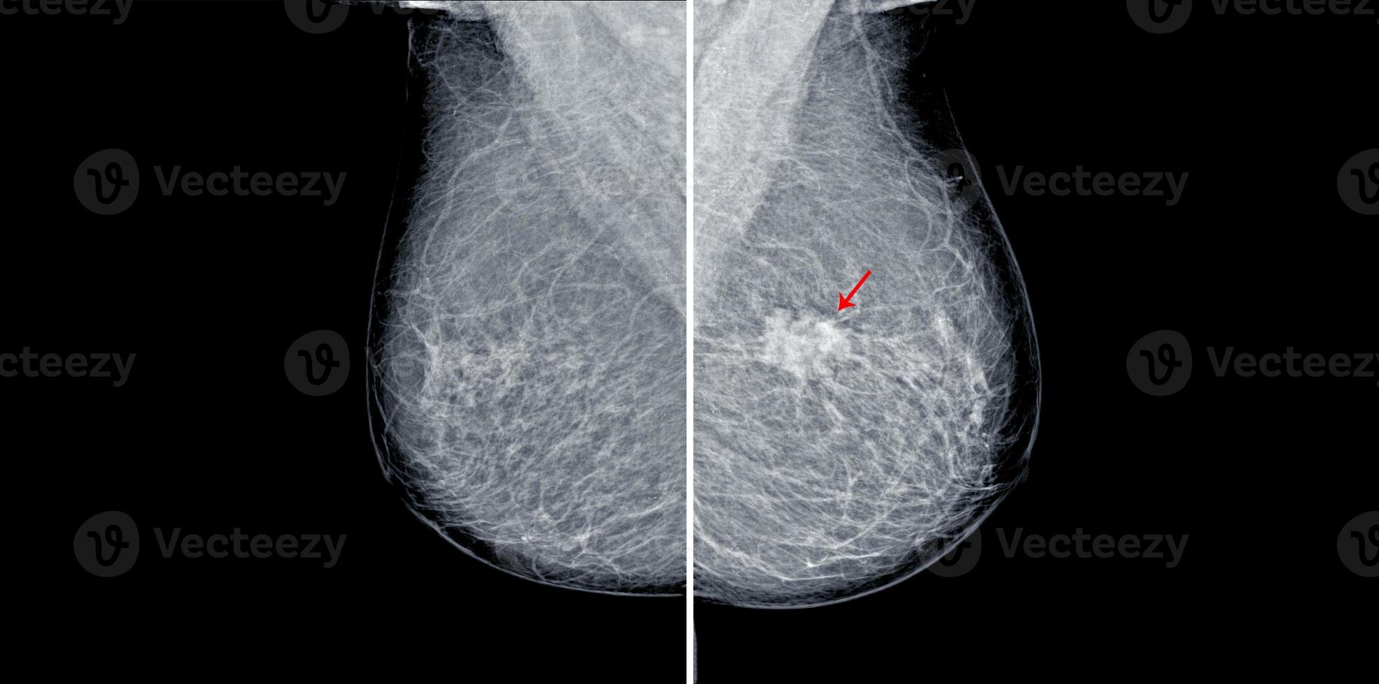 Mammogram radio imaging for breast cancer diagnosis photo