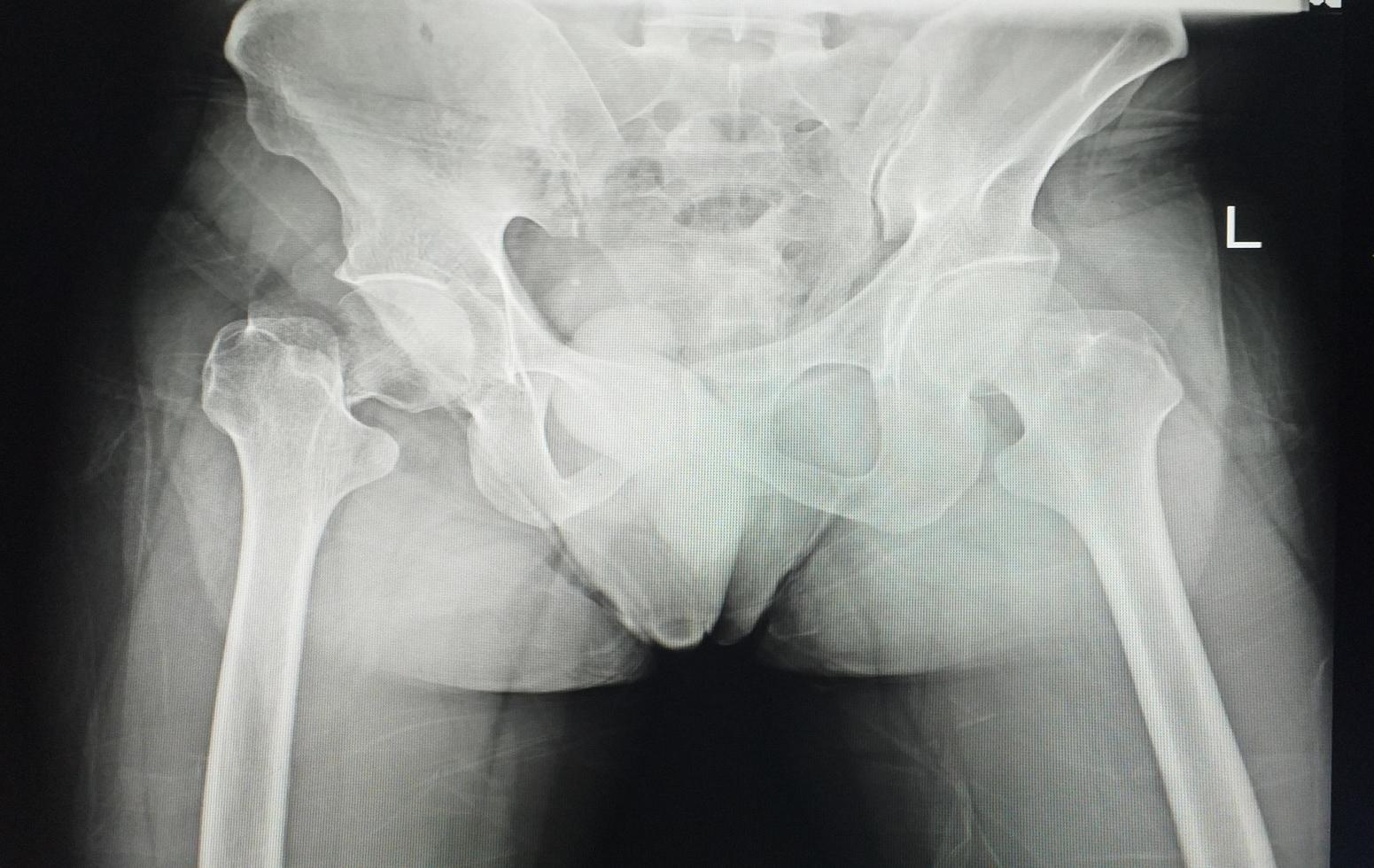 A pelvic x-ray showing closed fracture of intertrochanter of femur with displacement photo