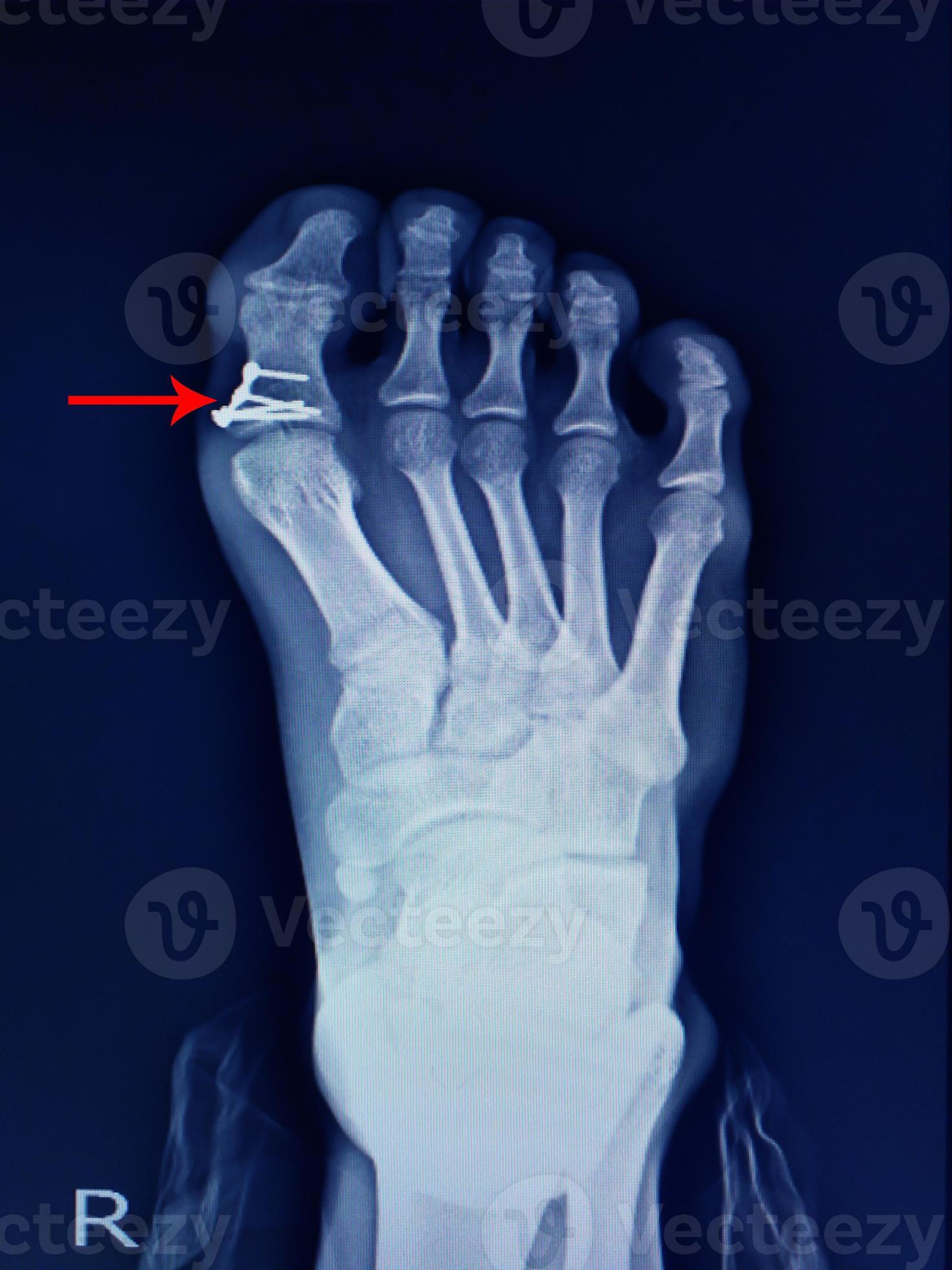 xray foot fracture proximal phalang and surgery fix mini plate and