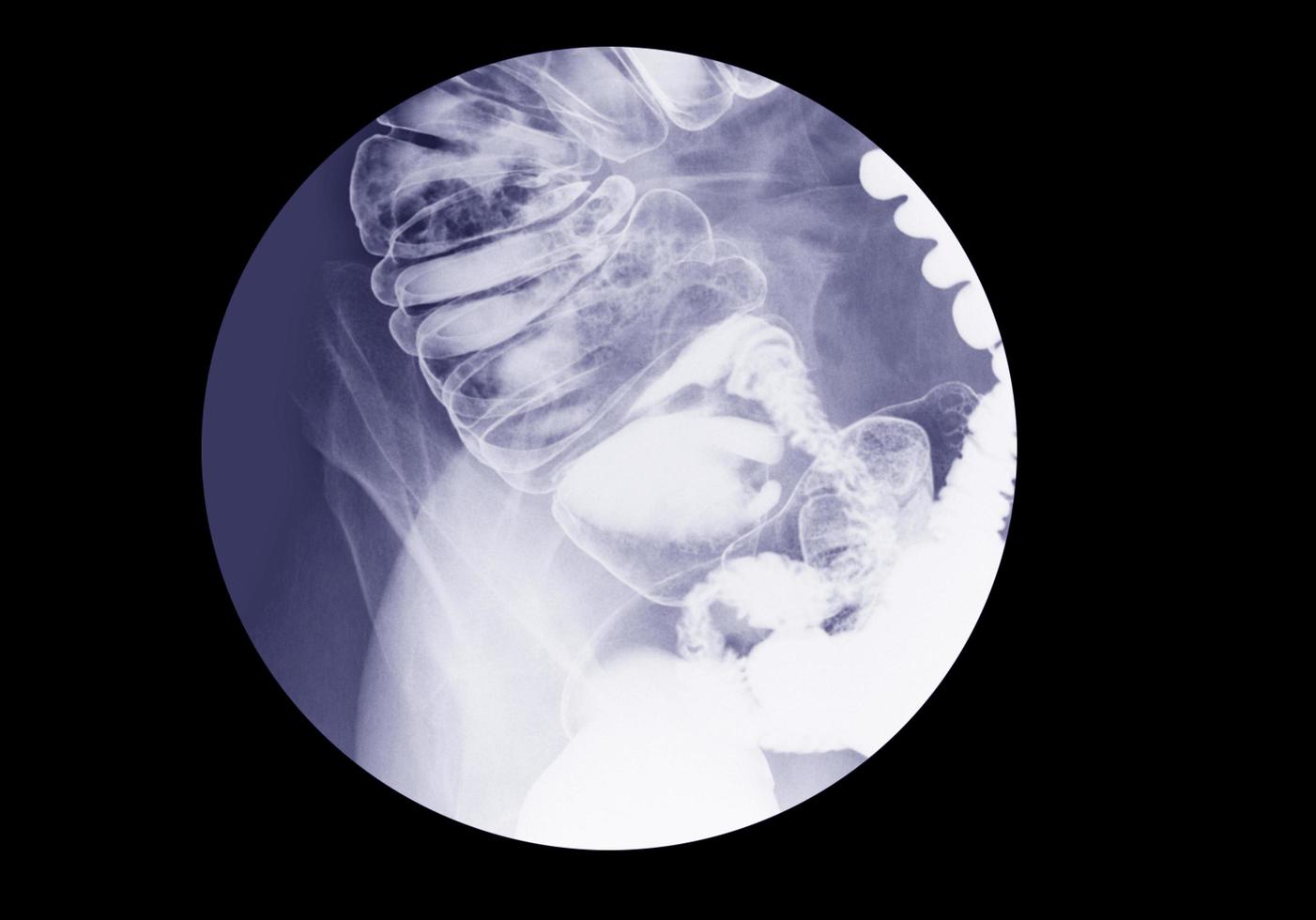 Barium enema examination lower gastrointestinal GI photo