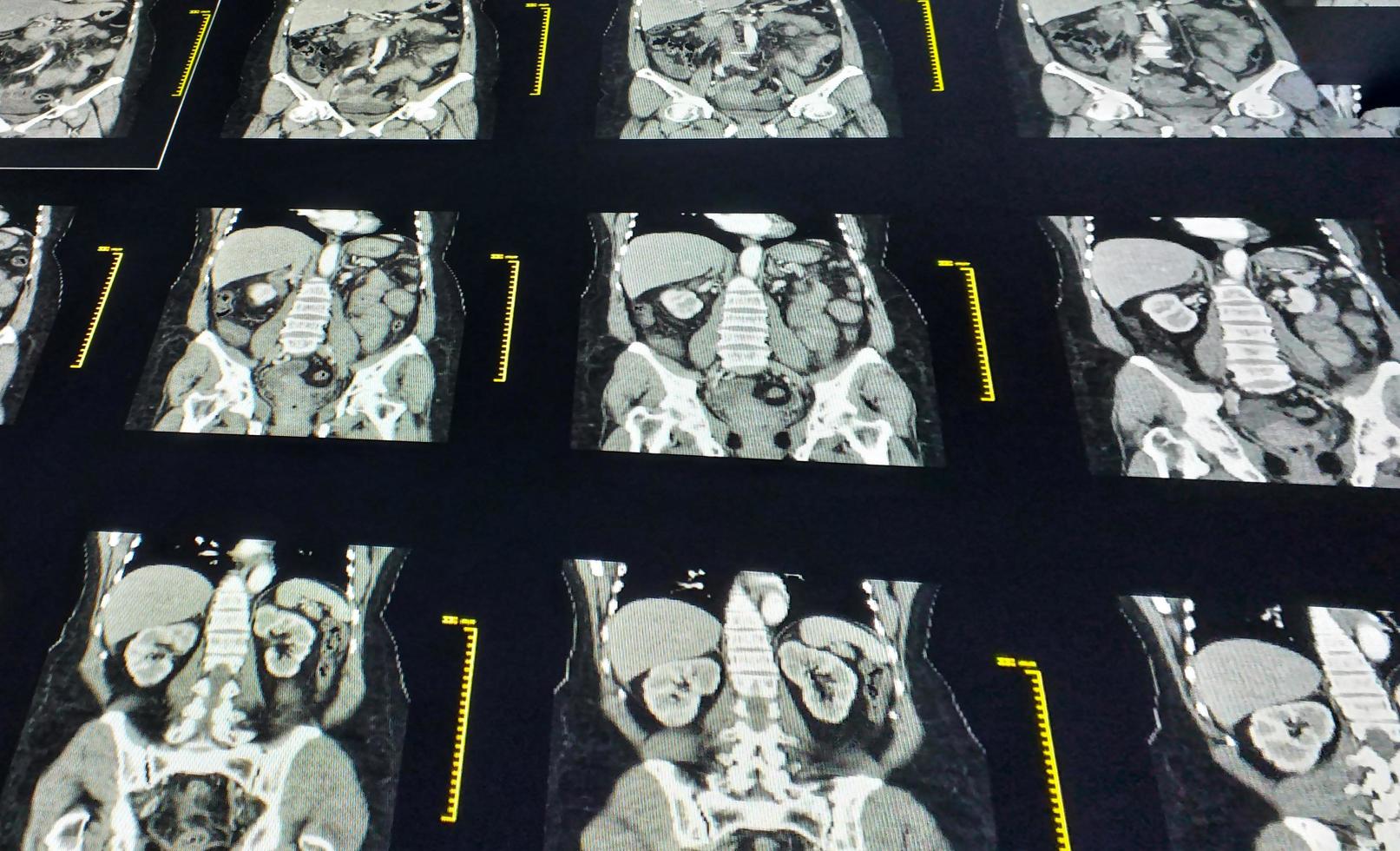 tomografía computarizada de abdomen completo con vista coronal de medio de contraste. concepto de tecnología médica. foto