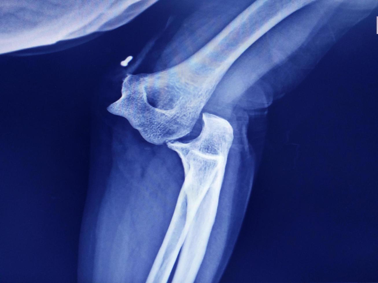 imagen de rayos x de dislocación de la articulación del codo. foto