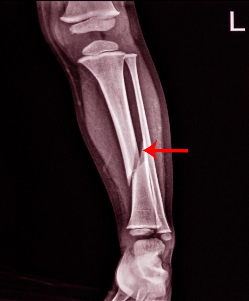 X-ray Left Leg AP Lat fracture Tibia. photo