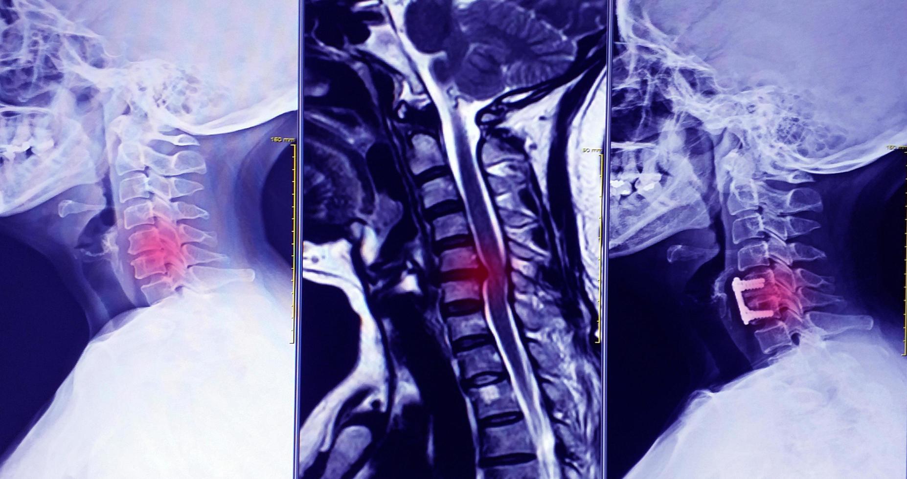 Cervical spine 3 views photo
