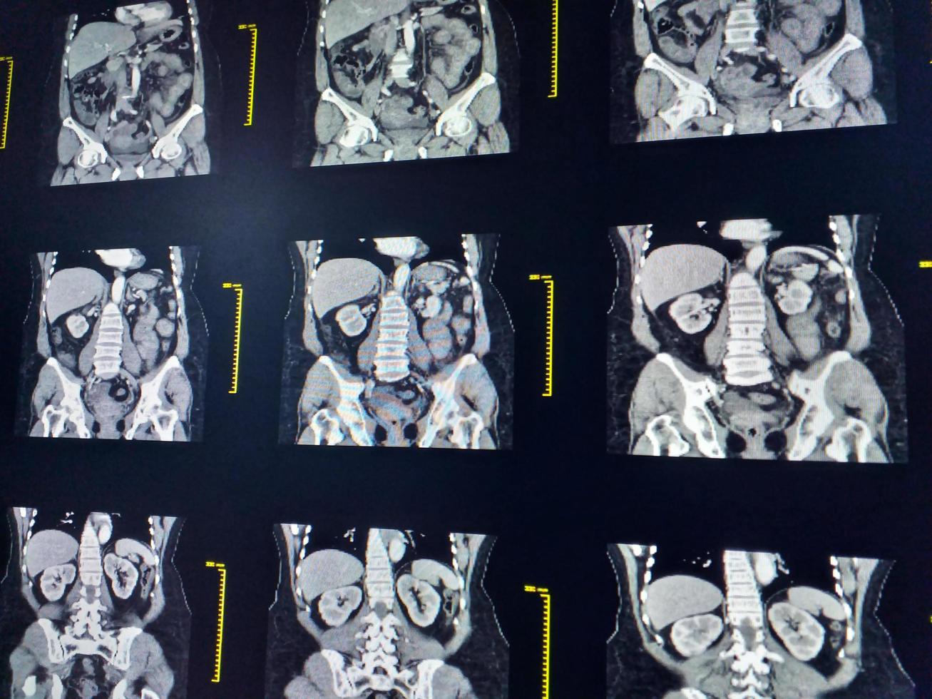 tomografía computarizada de abdomen completo con vista coronal de medio de contraste. concepto de tecnología médica. foto
