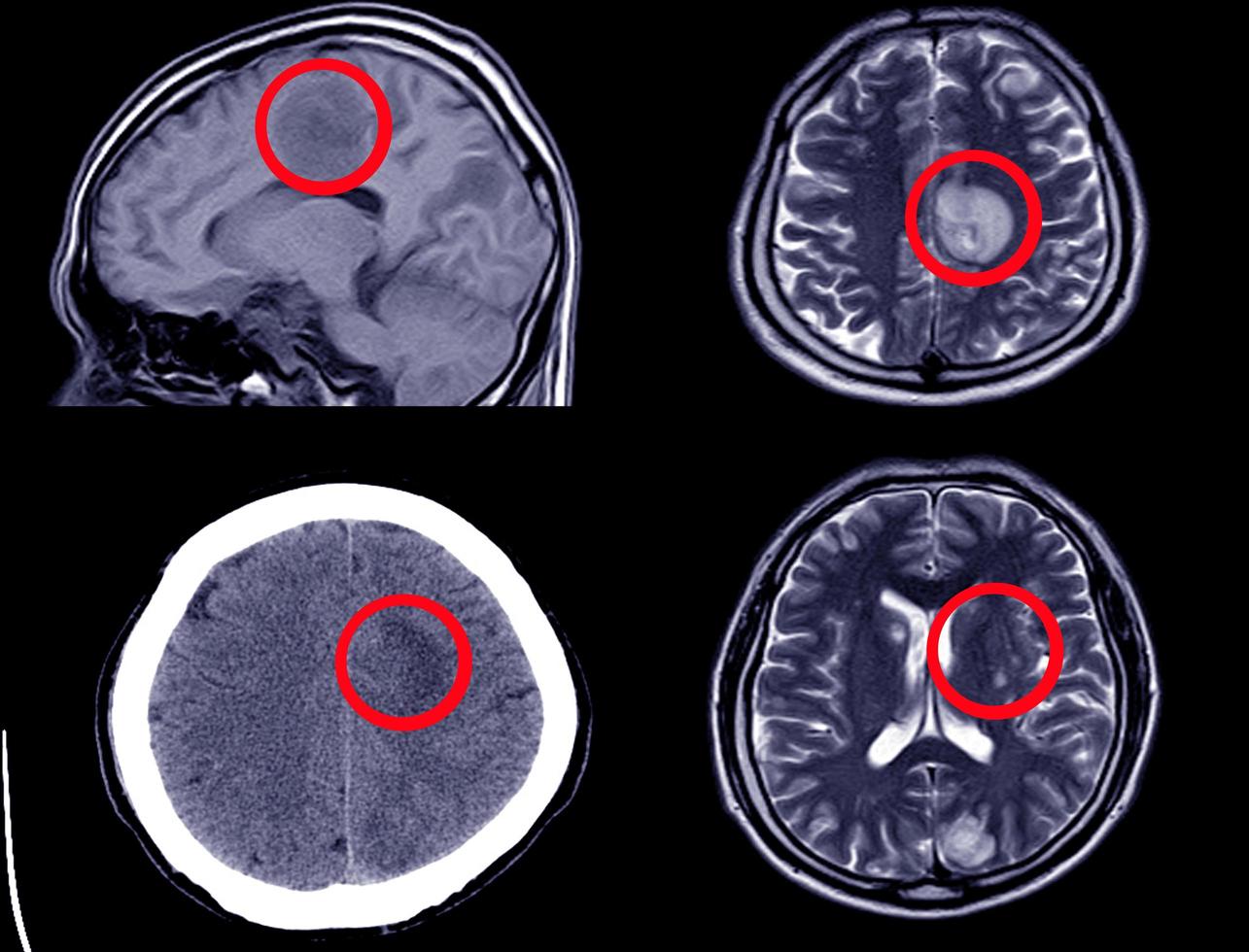 CT Scan of Brain showing Intracerebral Haemorrhage - Axial View photo