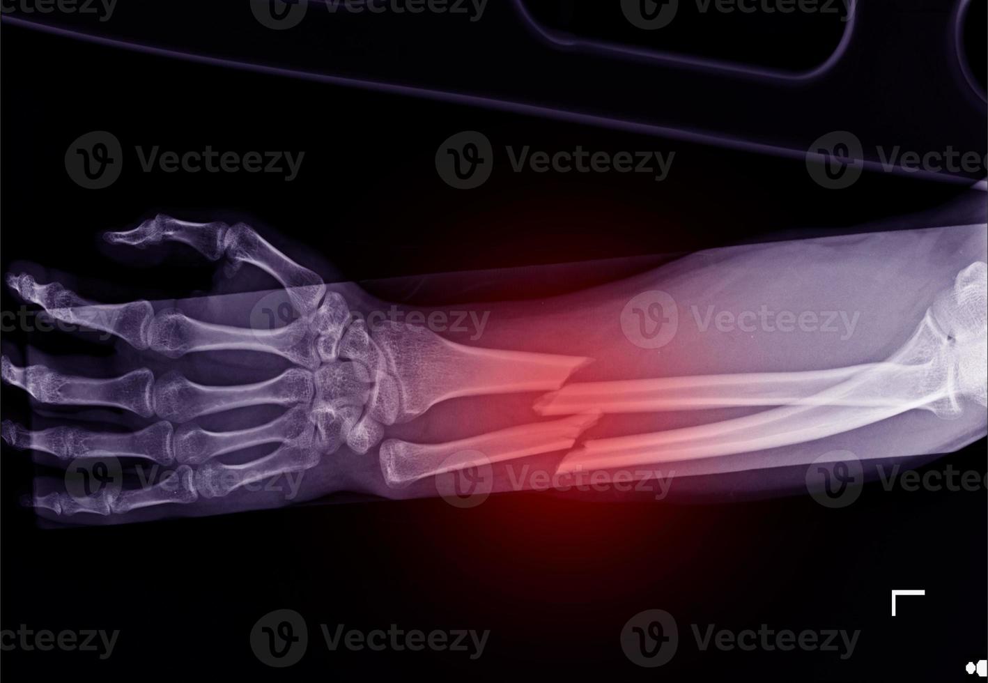 fracture shaft of radius and ulnar bone photo