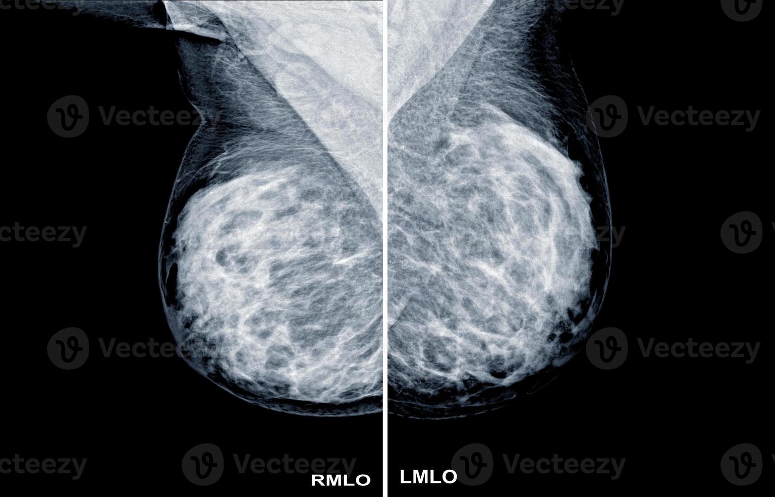Imágenes de radio de mamografía para el diagnóstico de cáncer de mama foto