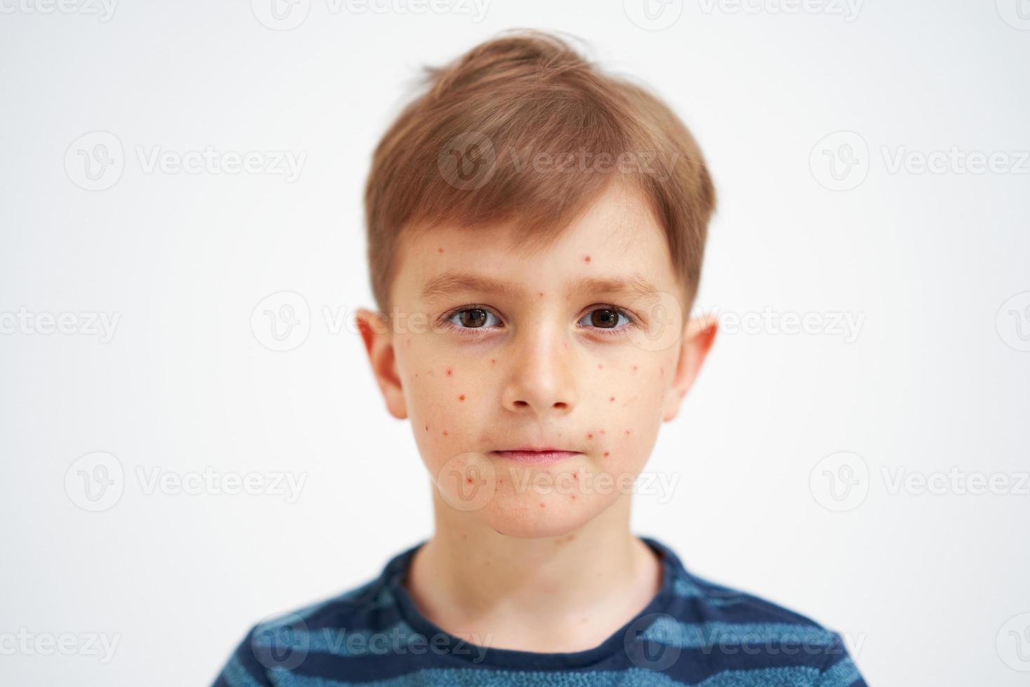 Young boy having chickenpox pictures of skin photo