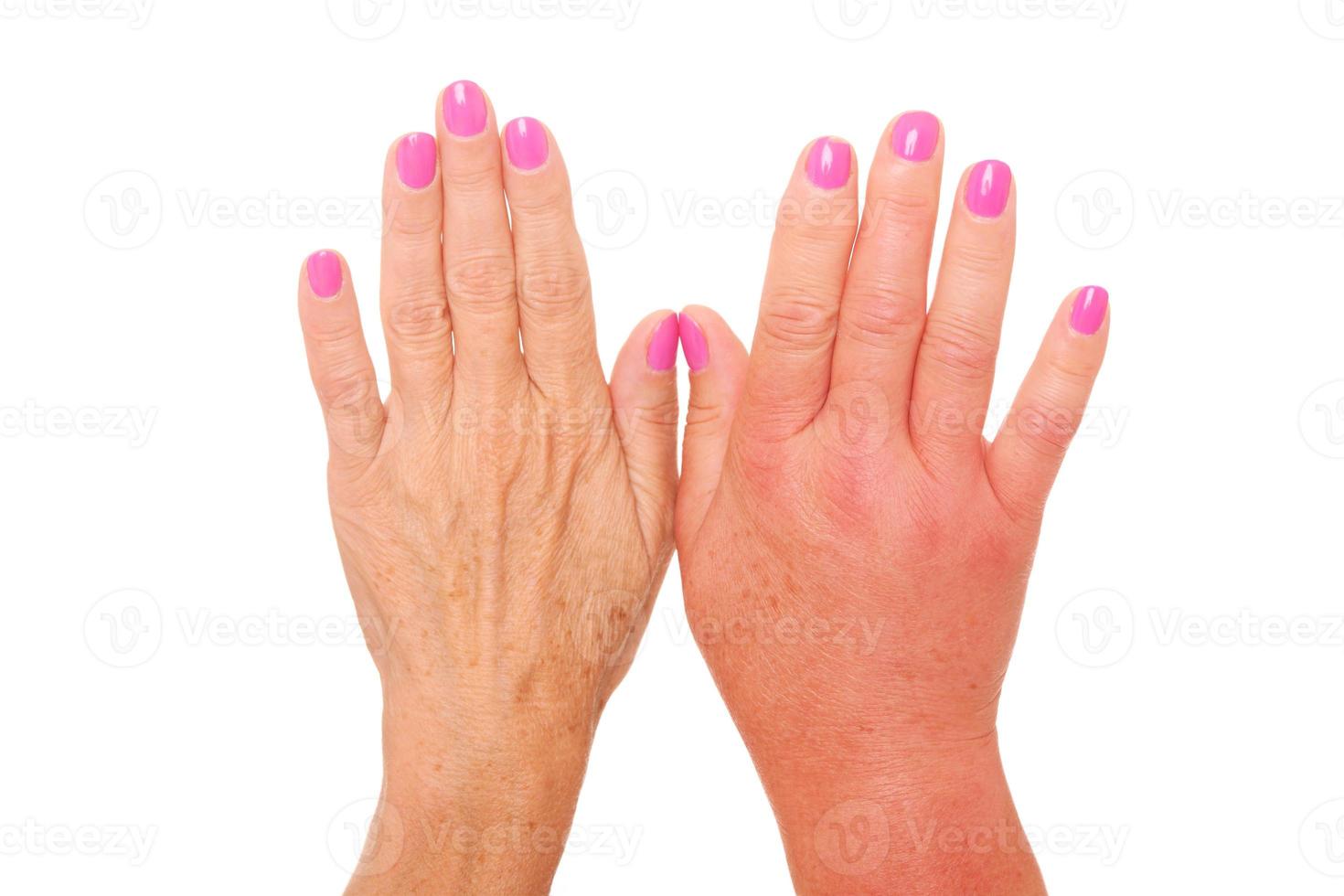 Swollen hand close-up photo