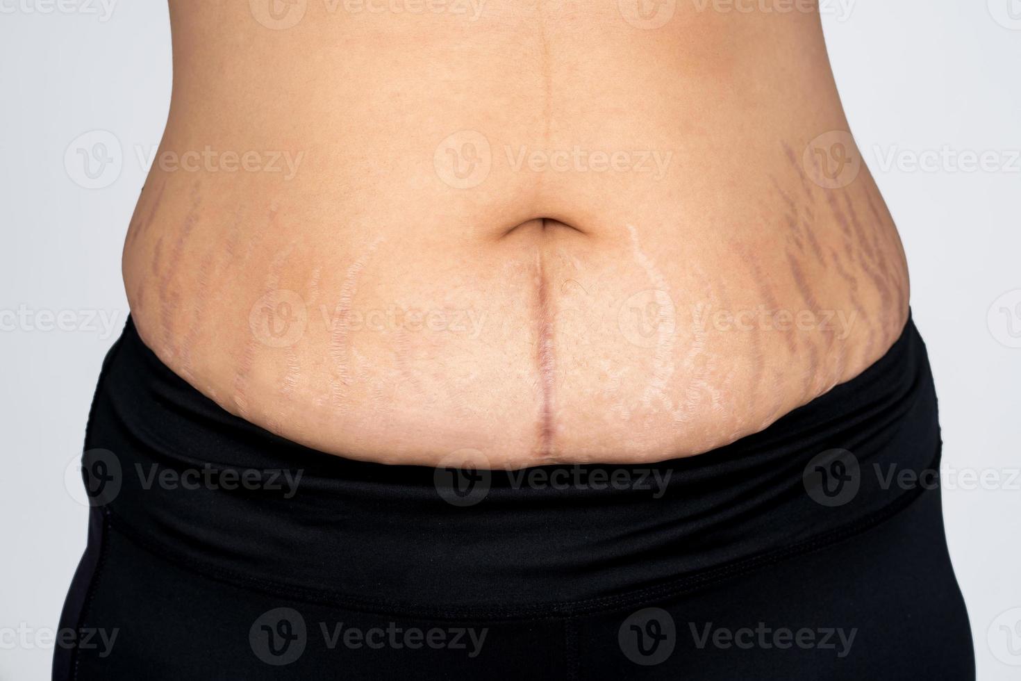 Pregnant womon resulting in striped belly skin Fat and scar. Skin and body care. photo