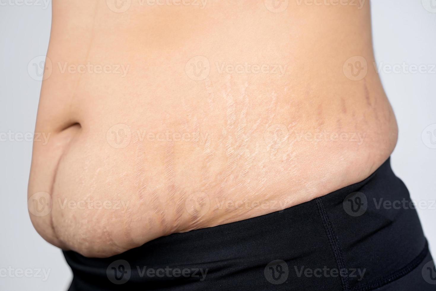 Womon with paunch and Abdominal stripes after having a child concept of Skin and body care. photo