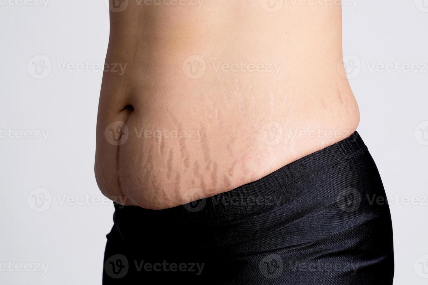 Photo of woman with stretch marks and flabby skin after childbirth. Skin and body care.