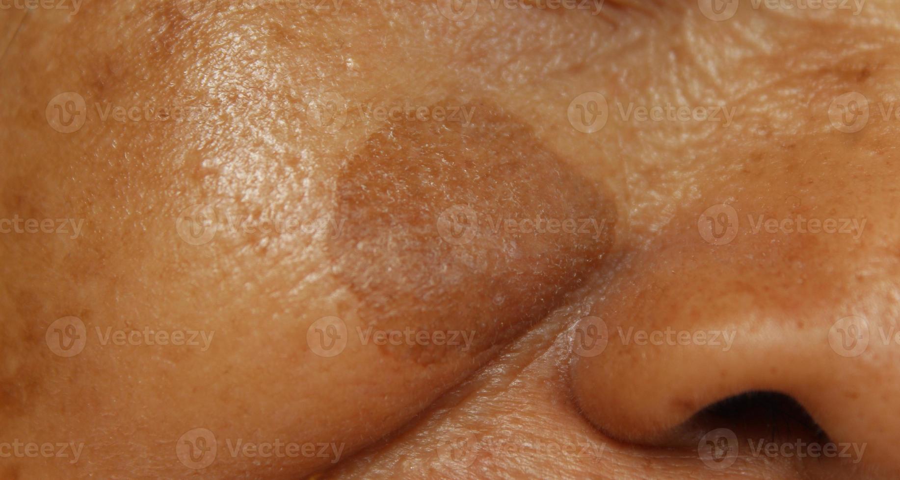 Small brown patches called age spots on face of Asian elderly woman. They are also called liver spots, senile lentigo, or sun spots. Wrinkles around closed eye of Asian elder woman. Closeup view photo