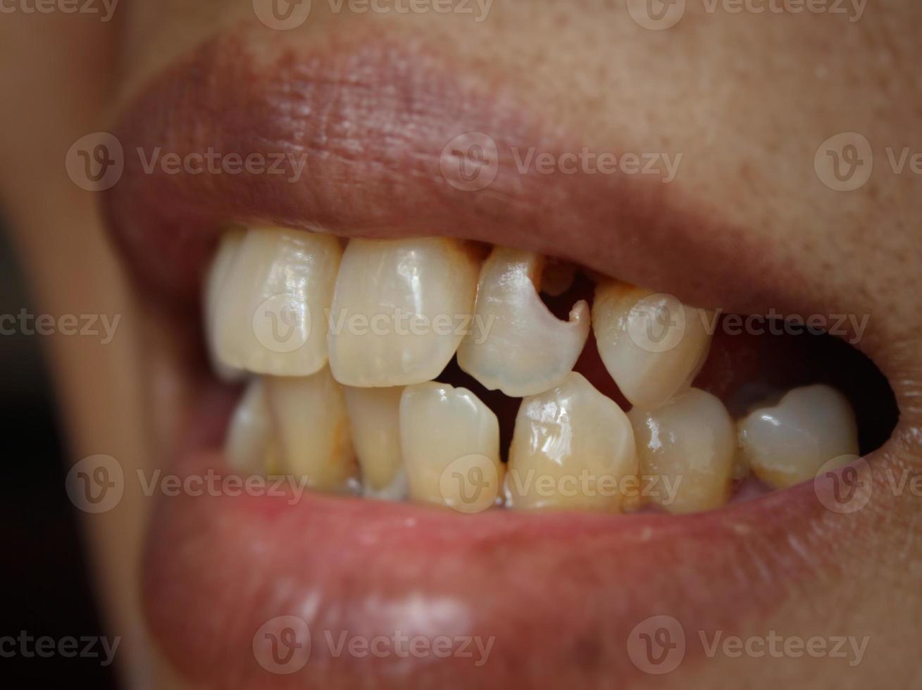 Decaying maxillary teeth photo