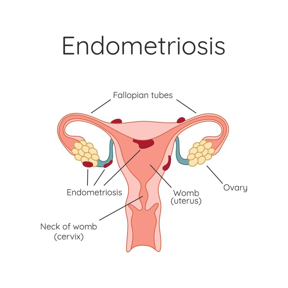 Endometriosis. The appearance of the disease endometriosis. Endometrium. Infographic vector