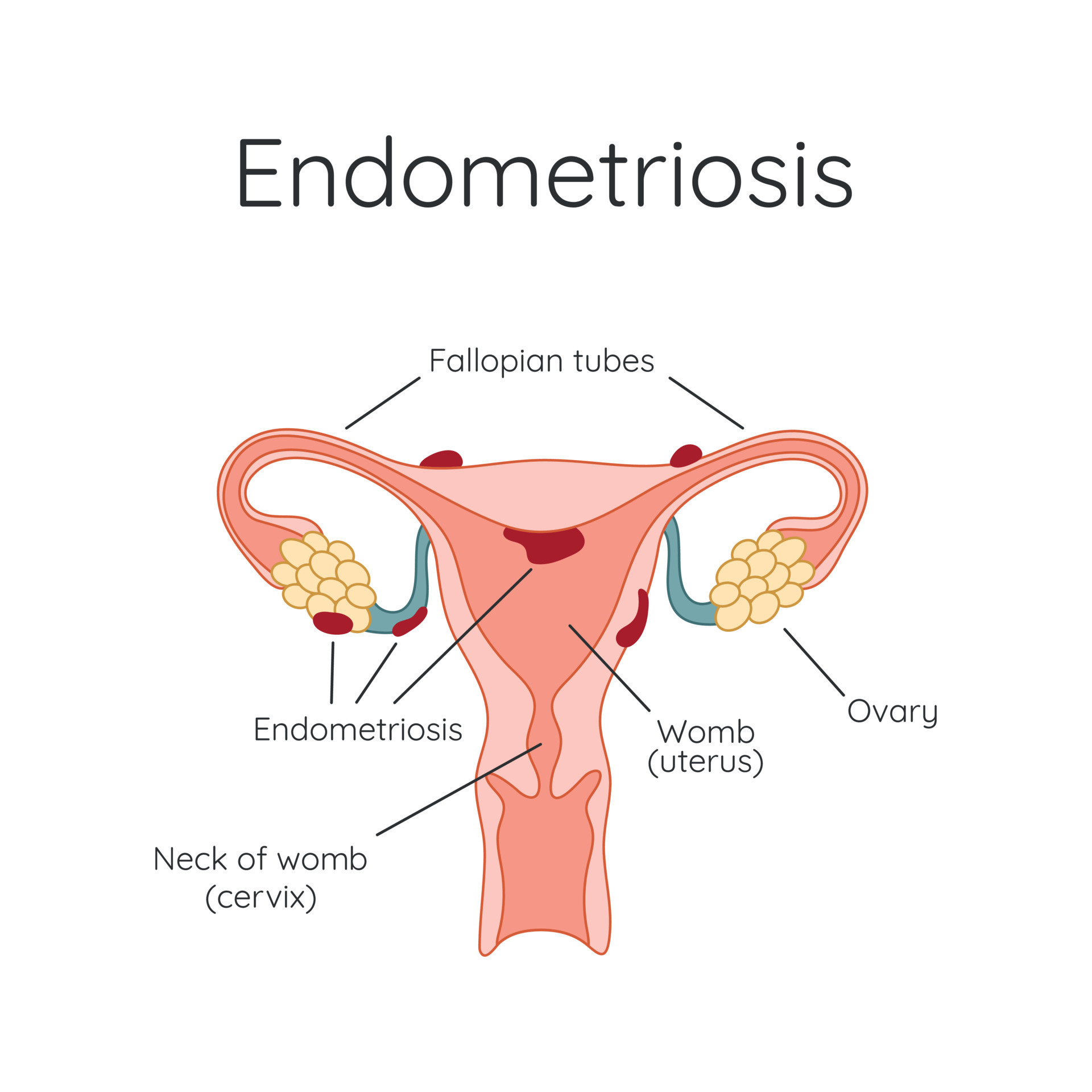 Endometriosis. The appearance of the disease endometriosis. Endometrium