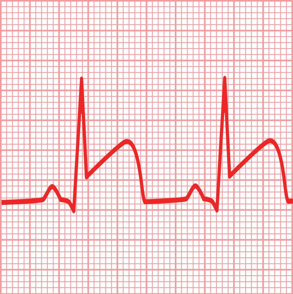 depicts ECGs for myocardial infarction. Heart attack sign. coronary artery thrombosis symbol. flat style. vector