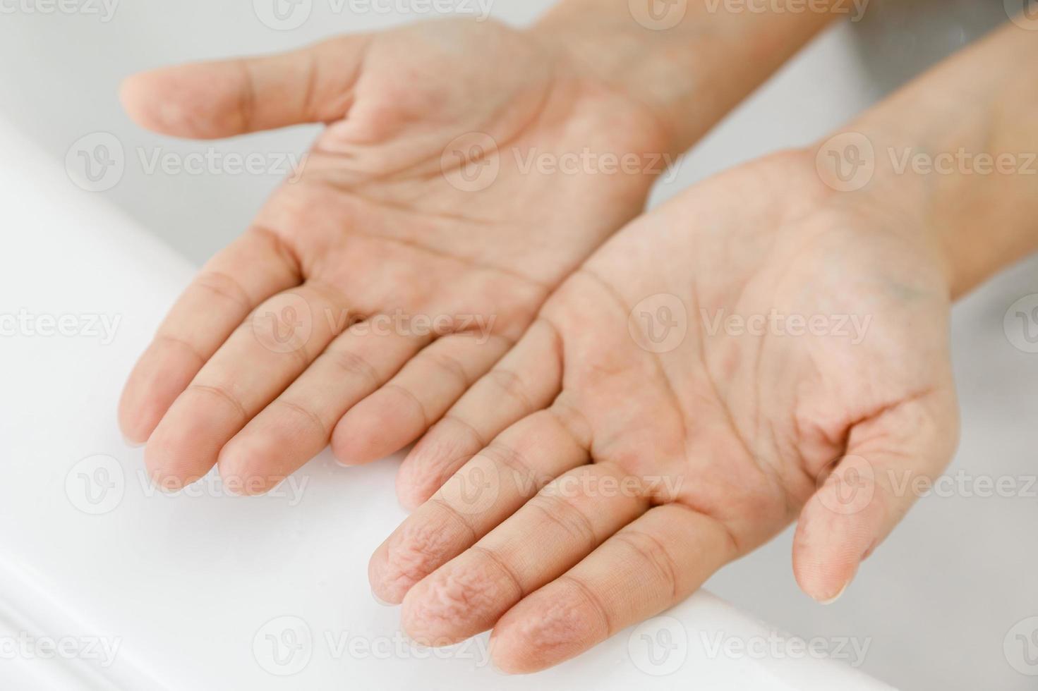 Comparision - female hands with wrinkles after bath photo