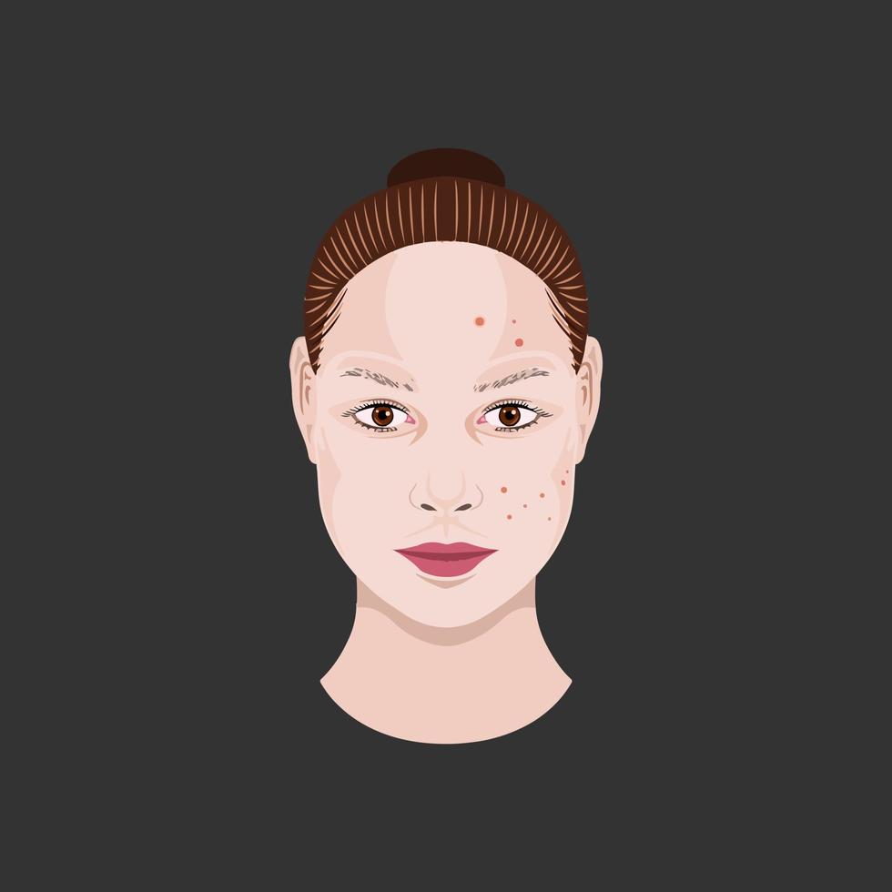Acne allergies vector inflammation damage scar disease design