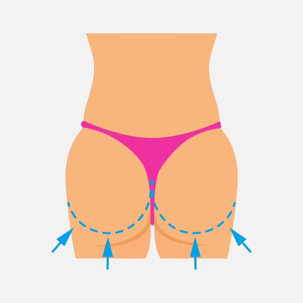 Cellulite removal, Before and after cellulite removal vector