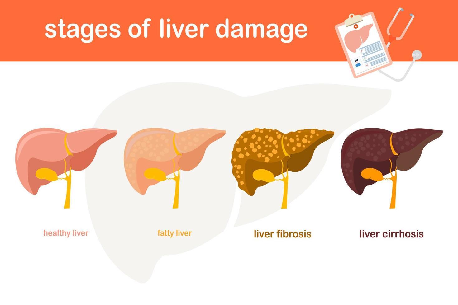 Stage vector illustration of liver damage  From Healthy Liver to Fatty liver.Liver fibrosis to cirrhosis  flat design  healthy concept