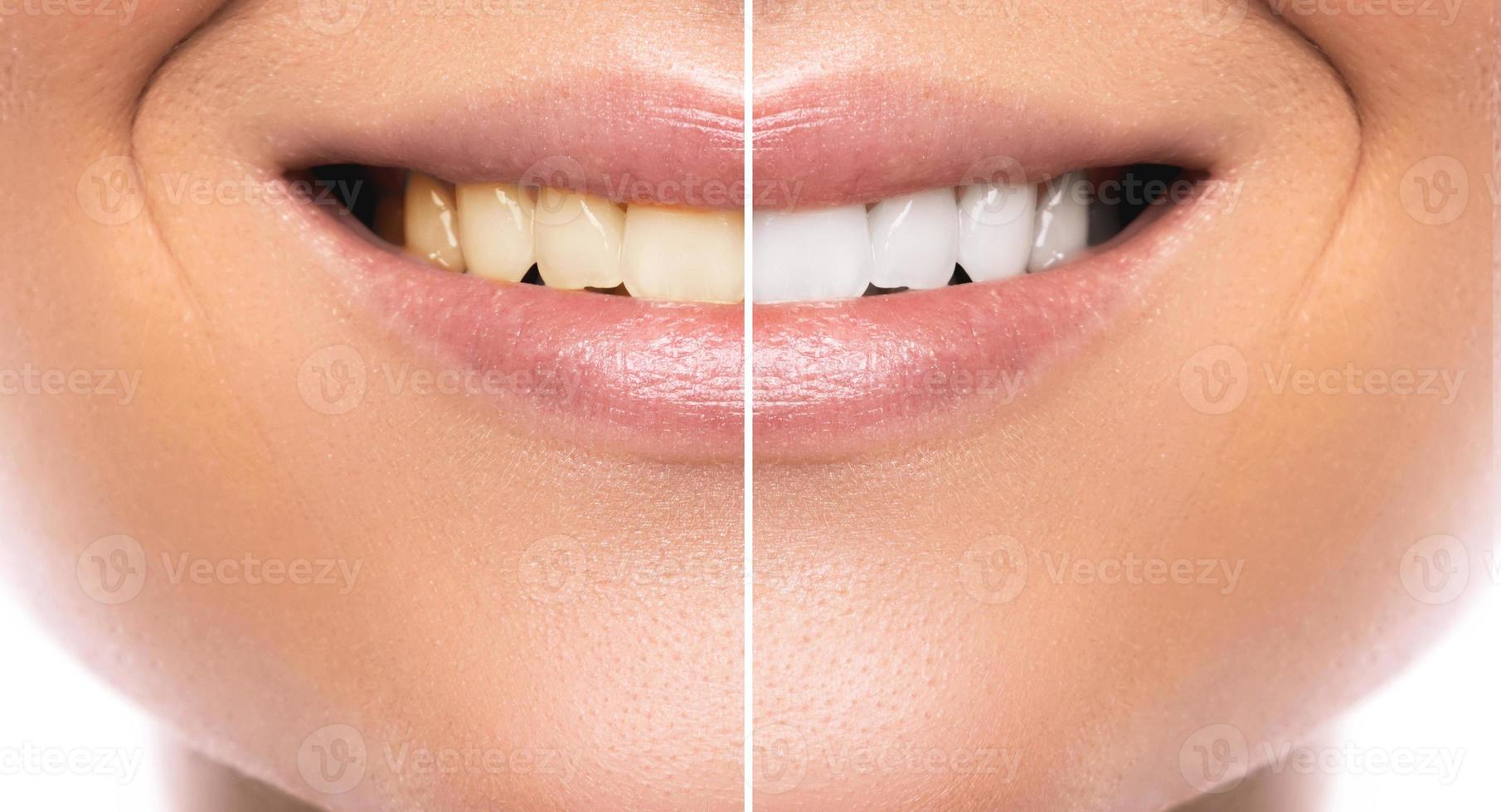 Female mouth. Comparison before and after teeth whitening photo