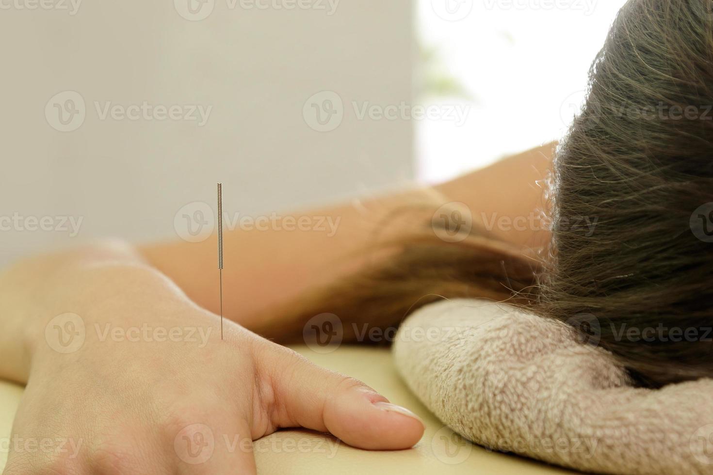 mano femenina con agujas de acero durante el procedimiento de terapia de acupuntura foto