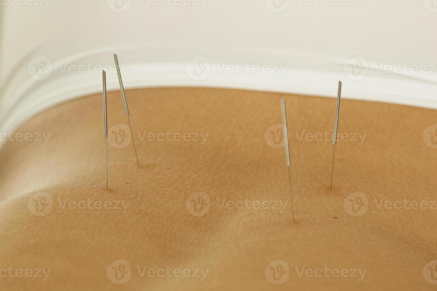 Female back with steel needles during procedure of acupuncture therapy photo