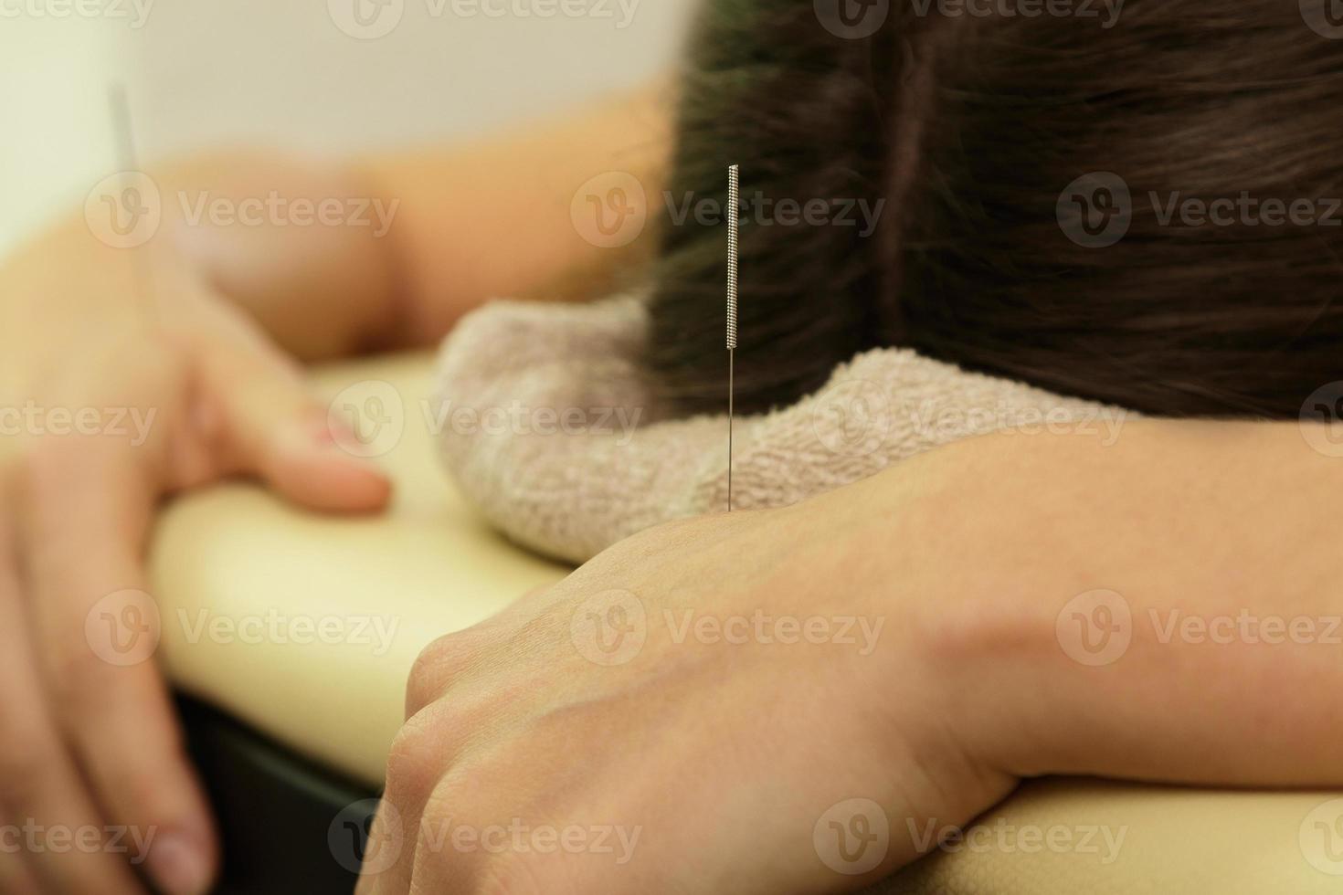 Female hand with steel needles during procedure of acupuncture therapy photo